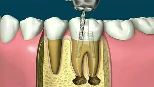 最新口腔根管治疗视频，引领牙科技术新时代的先锋